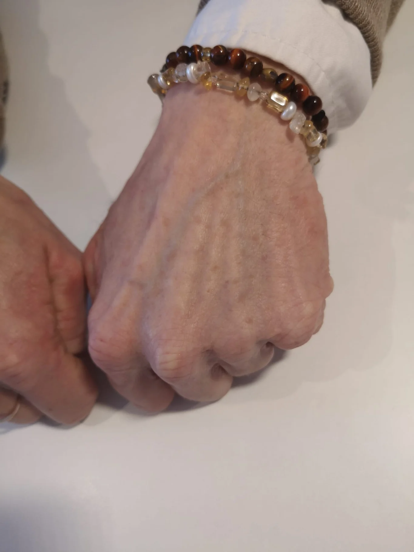 Originalaufnahme von Pigmentveränderungen am Handrücken